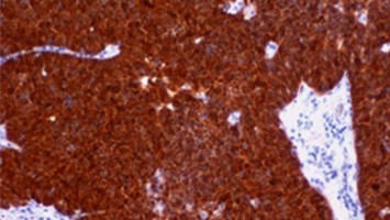 p16 INK4a -Immunhistochemie von OPSCC
