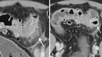Akute Sigmadivertikulitis