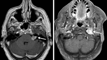 Tumor im linken Kleinhirnbrückenwinkel und inneren Gehörgang (linkes Bild) und Tumor am Foramen jugulare (rechtes Bild)