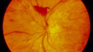 Proliferative diabetische Retinopathie