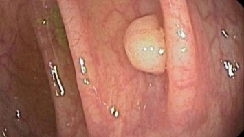 Darmpolyp