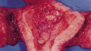 Adenokarzinom des Endometriums