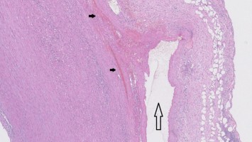 Aortendissektion und intramurale Hämatome