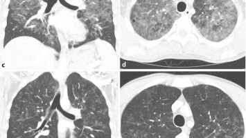 Pneumocystis-jirovecii-Pneumonie in der CT