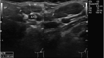 Morbus Castleman: Sonographie eines Lymphknotens