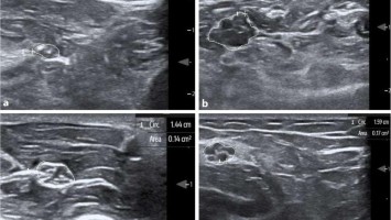 Sonographie bei Neuropathie-Patienten