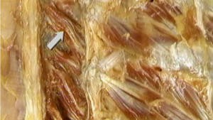 3.2 De m. erector spinae, de transversospinale spieren en het ruggenmerg_Picture