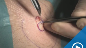 Dermis-Fett-Transplantation: Video 2