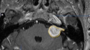 "Multisession radiosurgery" bei einem Patienten mit Vestibularisschwannom
