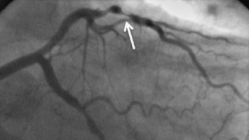 CT-Koronarangiographie eines Patienten mit Plaque im RIVA