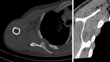 Knöcherne Ausziehung im Bereich der ventralen Skapulafläche