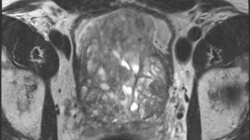 MRT-Befund einer benigne Prostatahyperplasie (BPH)