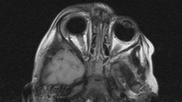 Verdacht auf beidseitige Optikusneuritis