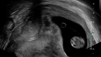 Transvaginalsonographie in der 11+1SSW