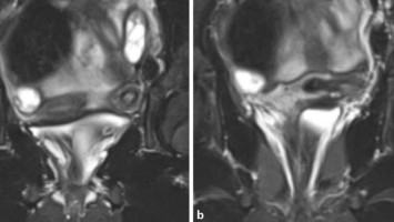 Magnetresonanztomographie, Darstellung der Doppelanlage des Uterus sowie des Mukokolpos