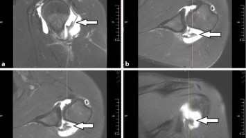 Arthro-MRT der linken Schulter