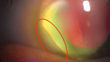 Periphere ulzerative Keratitis (PUK)