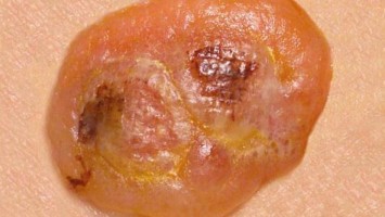 Ecthyma contagiosum am Unterarm