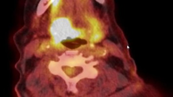 Plattenepithelkarzinom des Oropharynx