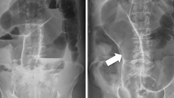 Akutes Abdomen (Röntgenbild)