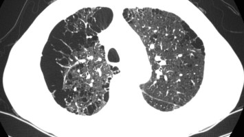 Nicht-kleinzelliges Bronchialkarzinom
