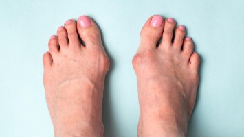 Hallux valgus