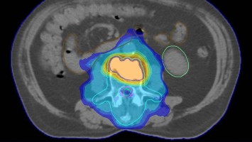 Bestrahlungsplans einer Wirbelsäulenmetastase eines oligometastasierten Prostatakarzinoms