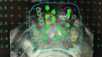 Fusionsbiopsie: Biopsieplan (Targets und systematische Biopsie) nach dem Eingriff
