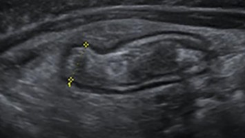 Appendizitis