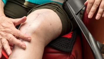 Narbe nach Kniegelenkersatz