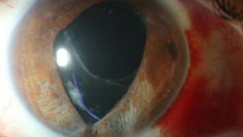 Feuerwerkskörperverletzung des Auges