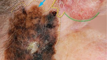 Tumor an der Schläfe