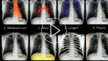 Vortrag PD Benedikt Pregler - Röntgen Thorax