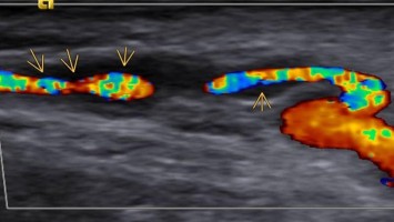 Riesenzellarteriitis