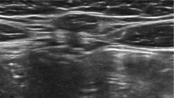 Umbilikale Narbenhernie