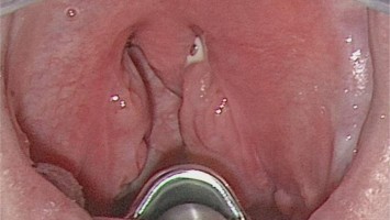 Peritonsillarabszess