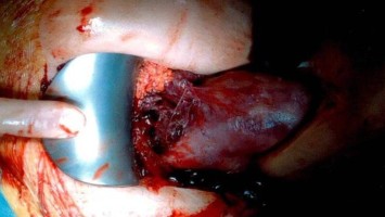 Endometriose in der Schwangerschaft 