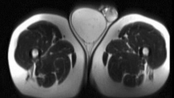 Liposarkom des Funiculus spermaticus