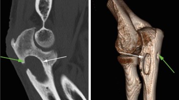 Chronische, granulomatöse Entzündung am Ellenbogen