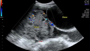 Sonographische Darstellung der Raumforderung