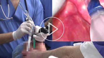 Startbild Video Doppellumentubus