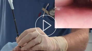 Startbild Video Fiberoptische Wachintubation