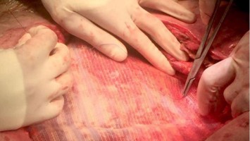 Bioabbaubares Mesh bei Hernie