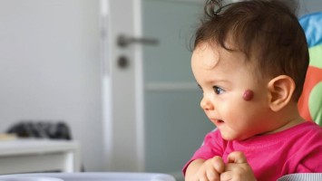 Infantiles Hämangiom