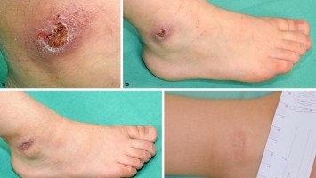 Malleolus lateralis vor und nach der Therapie