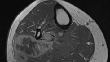 Lokales Kompartmentsyndrom