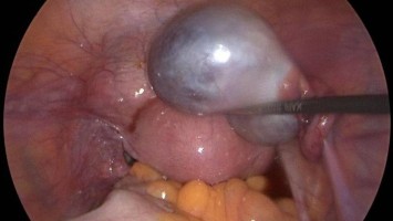 Ovarialzyste (intraoperatives Bild)