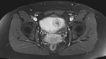 MRT-Darstellung einer uterinen Raumforderung