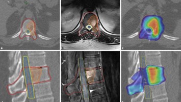 Stereotaktische Strahlentherapie (SBRT) einer solitären ossären Metastase in dem Brustwirbelkörper