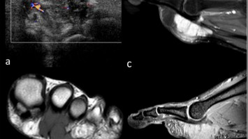 MRI en Echografie van een sarcoom